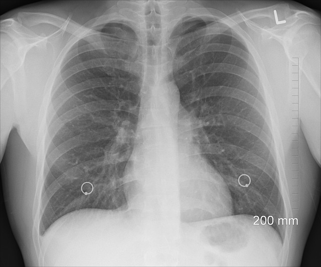 Unveiling Cancer’s Cues: Advanced Tumor Imaging with Ultrasound