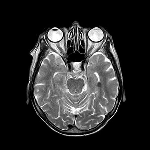 MRI: Unlocking Soft Tissue Tumor Secrets for Molecular Imaging